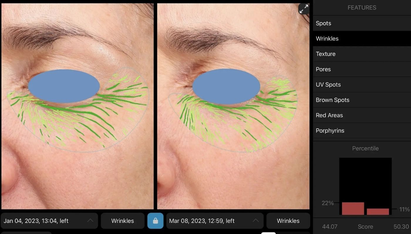 BBL - Before and After