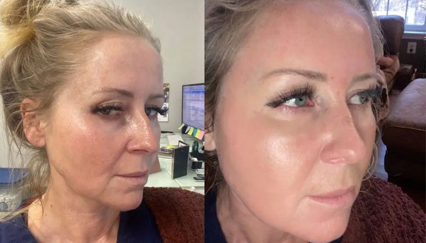 BBL - Before and After
