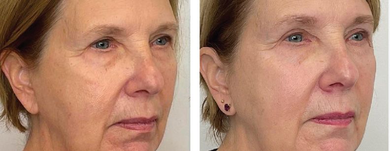 RF Microneedling with Exosomes - Before and After