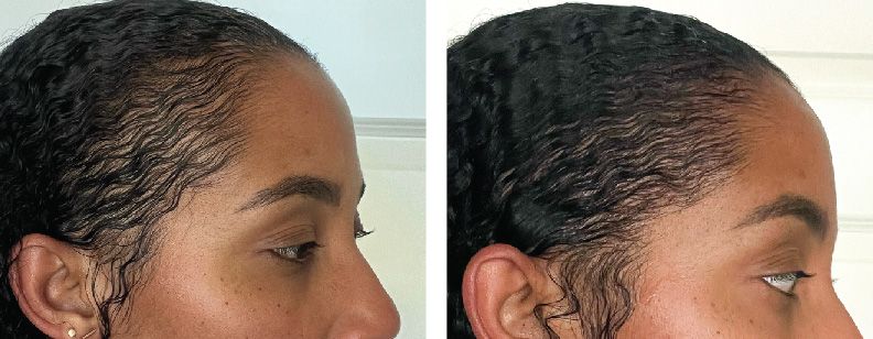 RF Microneedling with Exosomes - Before and After