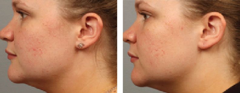 RF Microneedling with Exosomes - Before and After