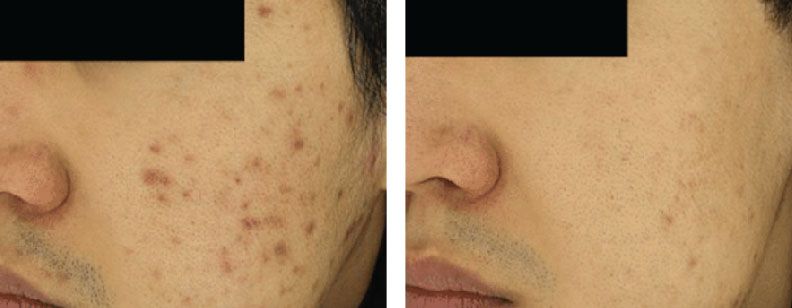 RF Microneedling with Exosomes - Before and After