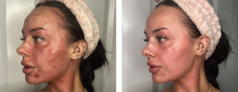 RF Microneedling with Exosomes - Before and After