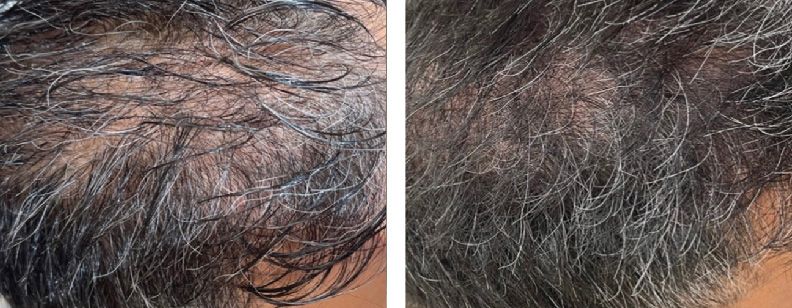 RF Microneedling with Exosomes - Before and After