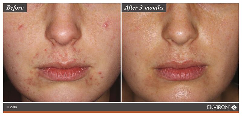 chemical peels Environ effect on skin