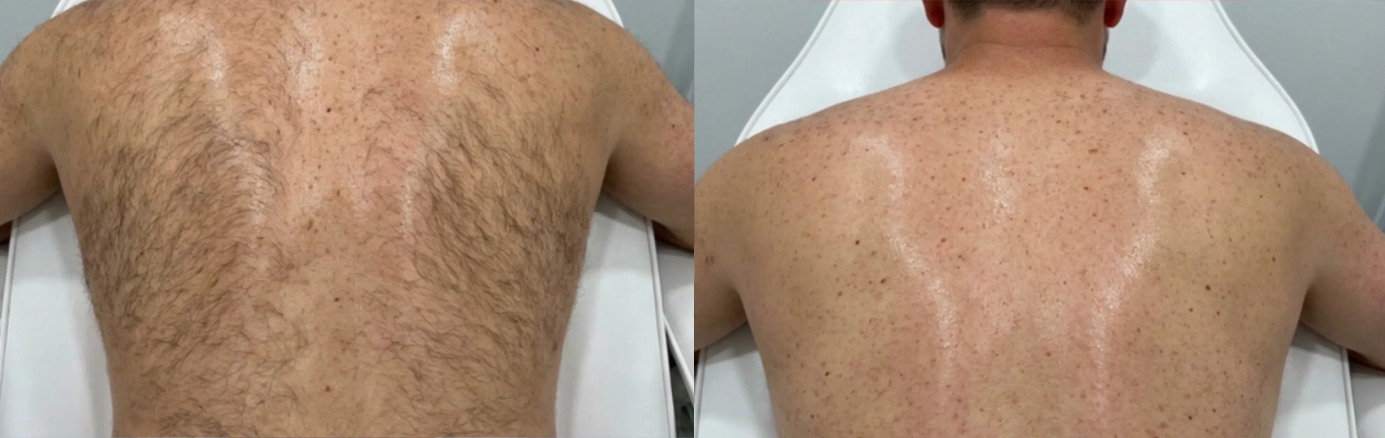 Laser Hair Removal GentleMax Pro | Boston, MA before and after