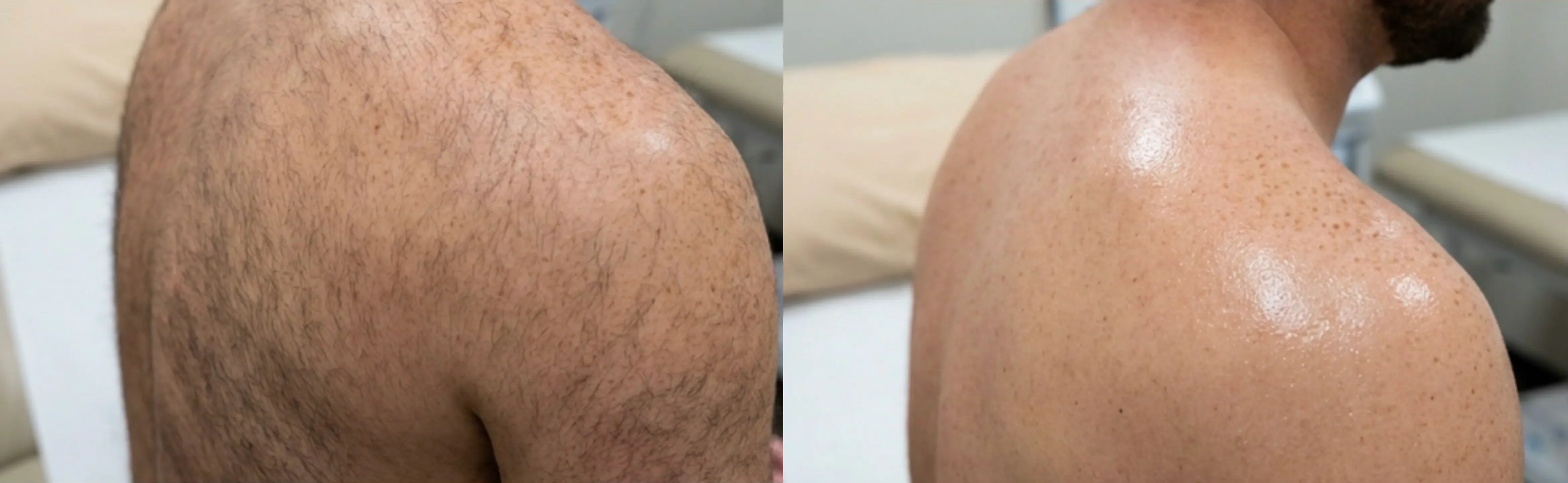 Laser Hair Removal GentleMax Pro | Boston, MA before and after