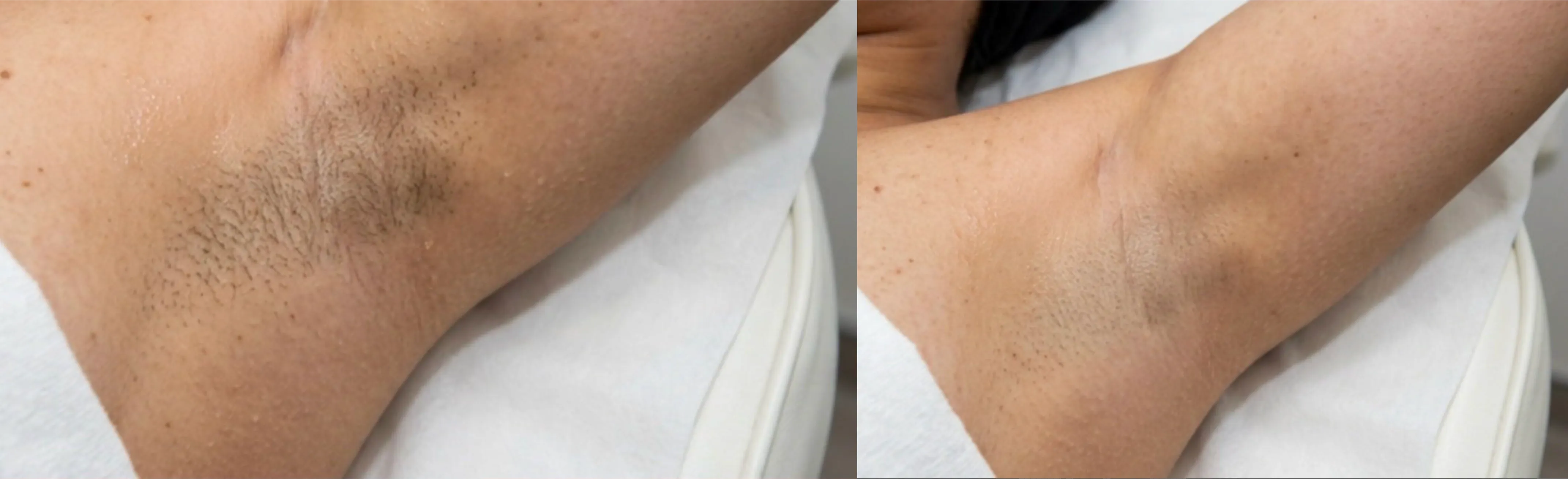 Laser Hair Removal Elite iQ | Cambridge, MA before and after