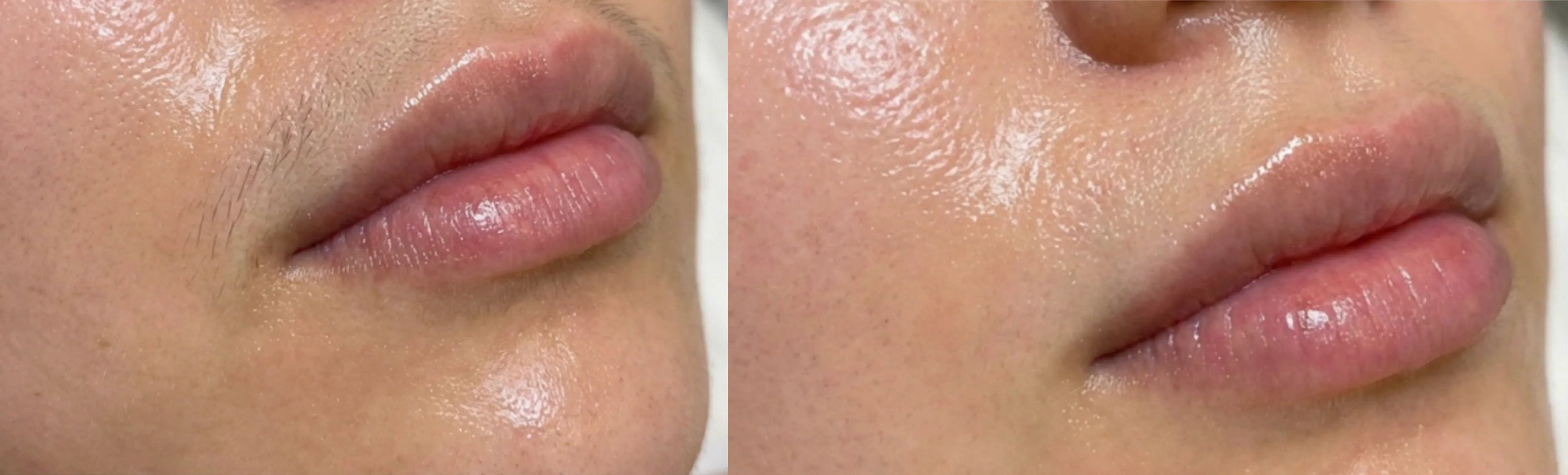 Laser Hair Removal Elite iQ | Cambridge, MA before and after