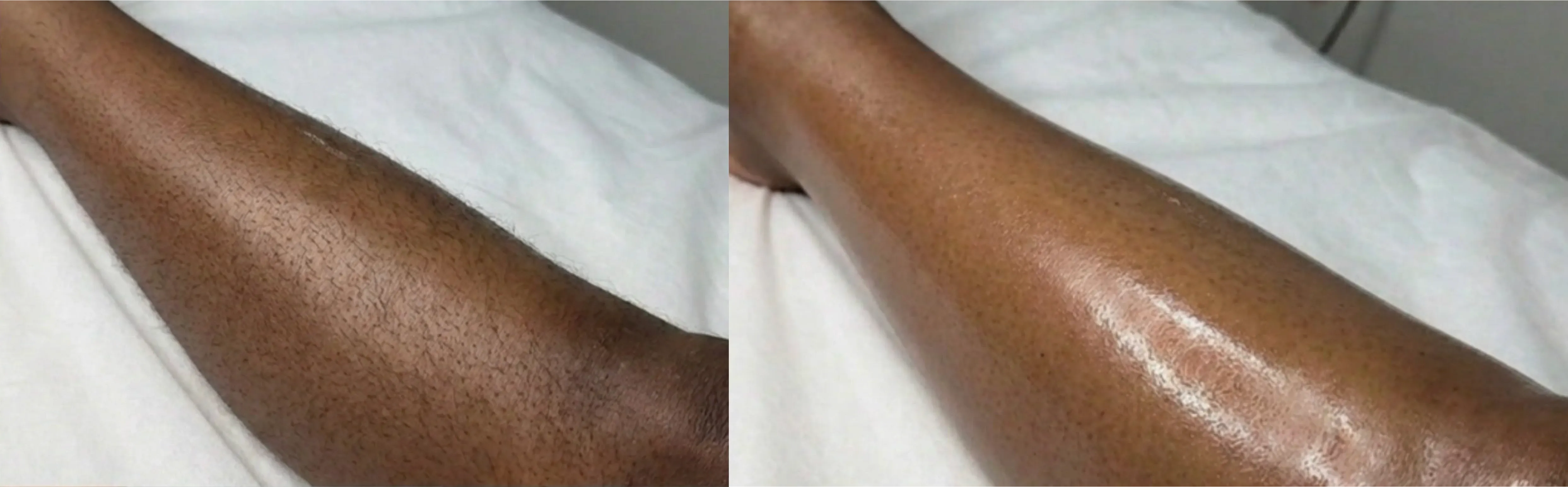 Laser Hair Removal GentleMax Pro | Boston, MA before and after