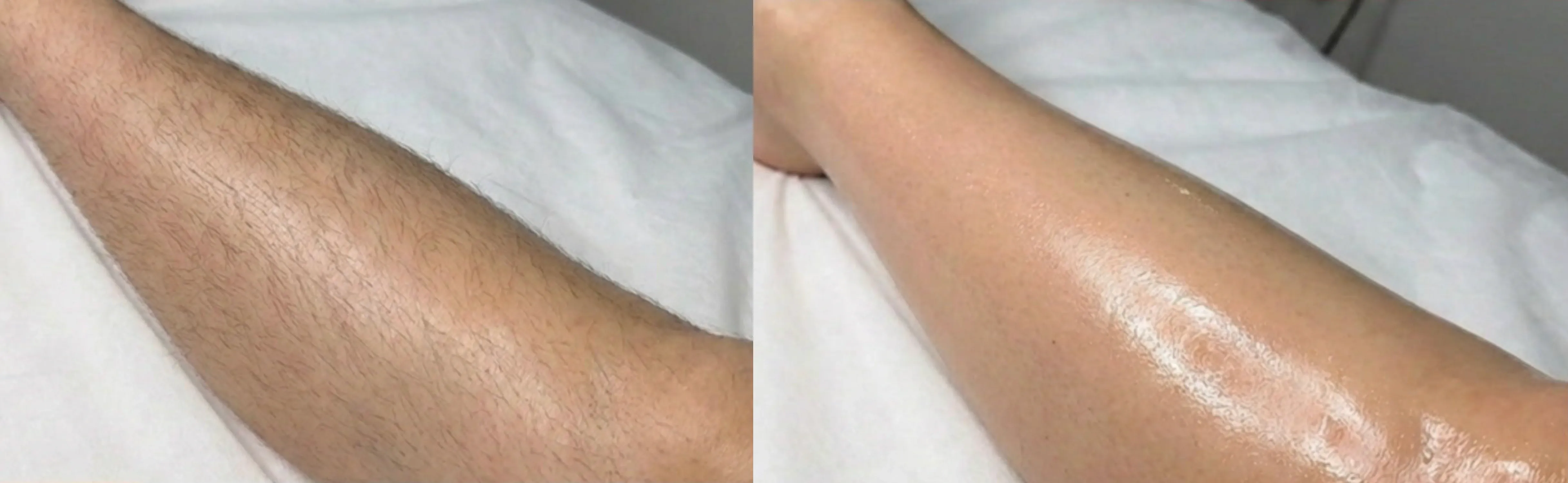 Laser Hair Removal GentleMax Pro | Boston, MA before and after