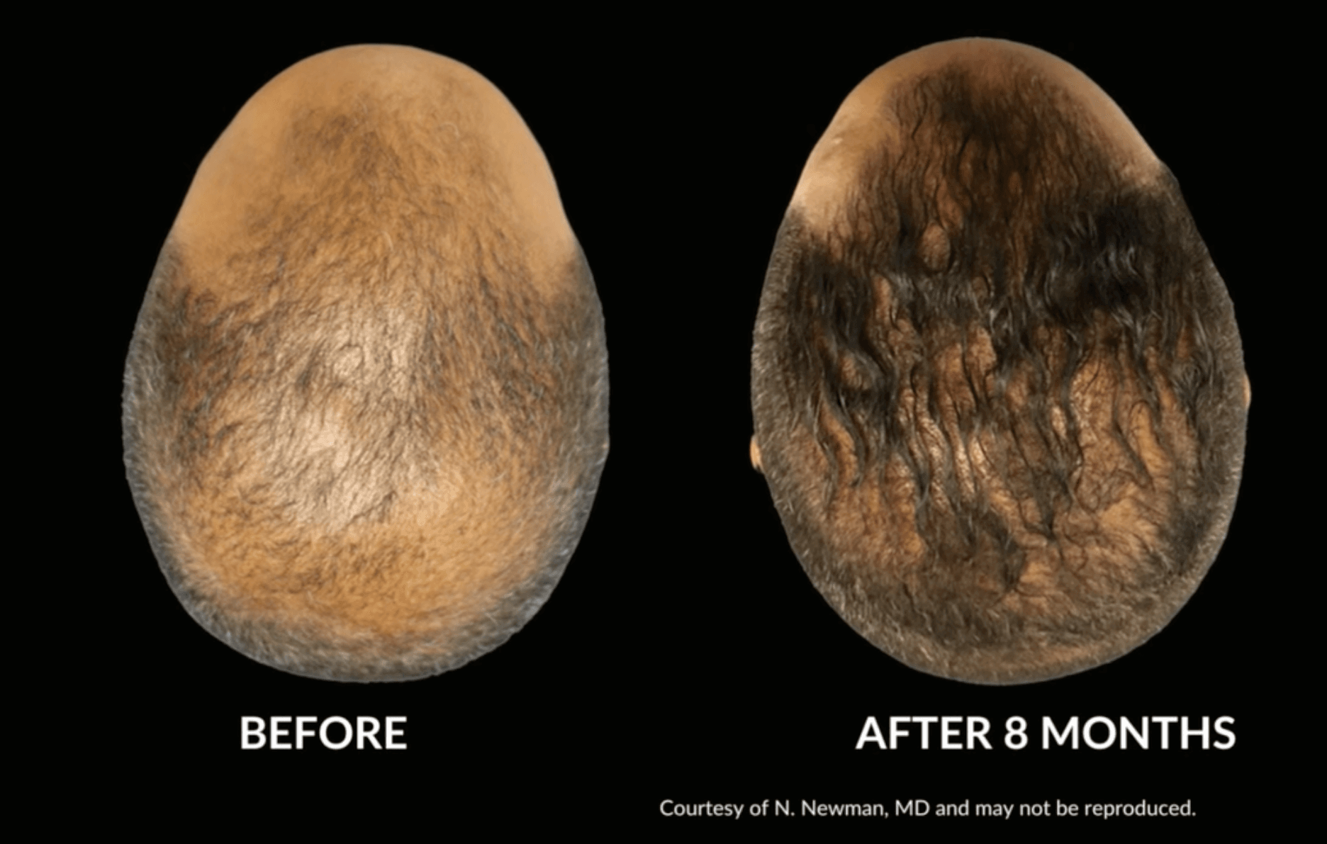 hair restoration with DE|RIVE before and after