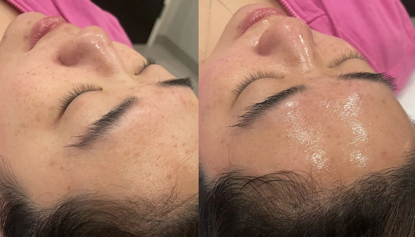 Chemical Peels before and after