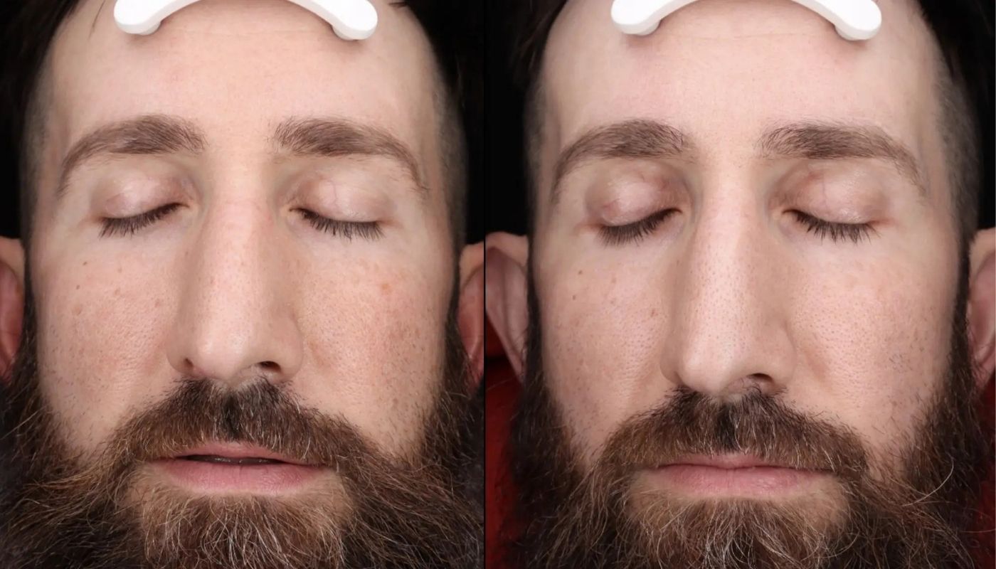 Chemical Peels before and after