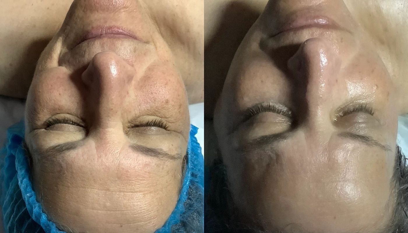 Custom Facial before and after