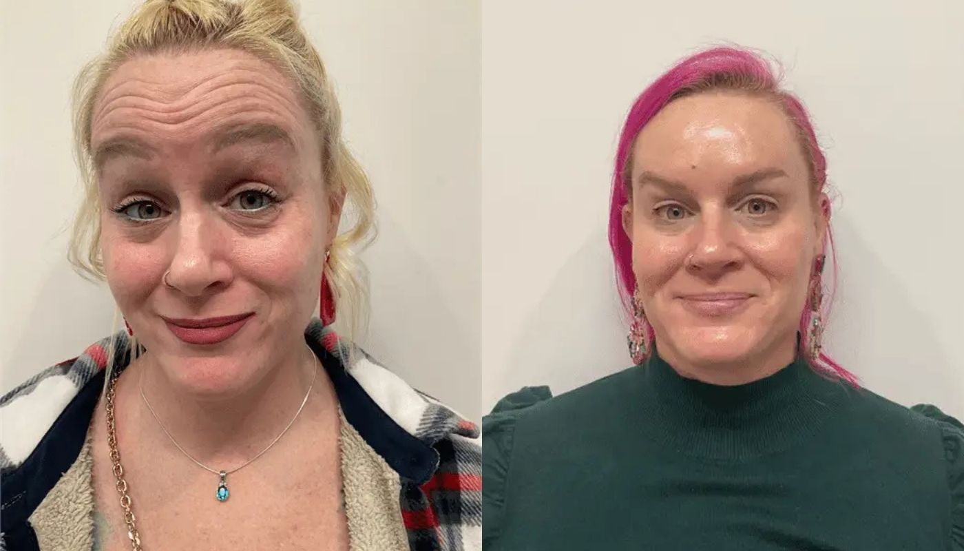 Daxxify before and after