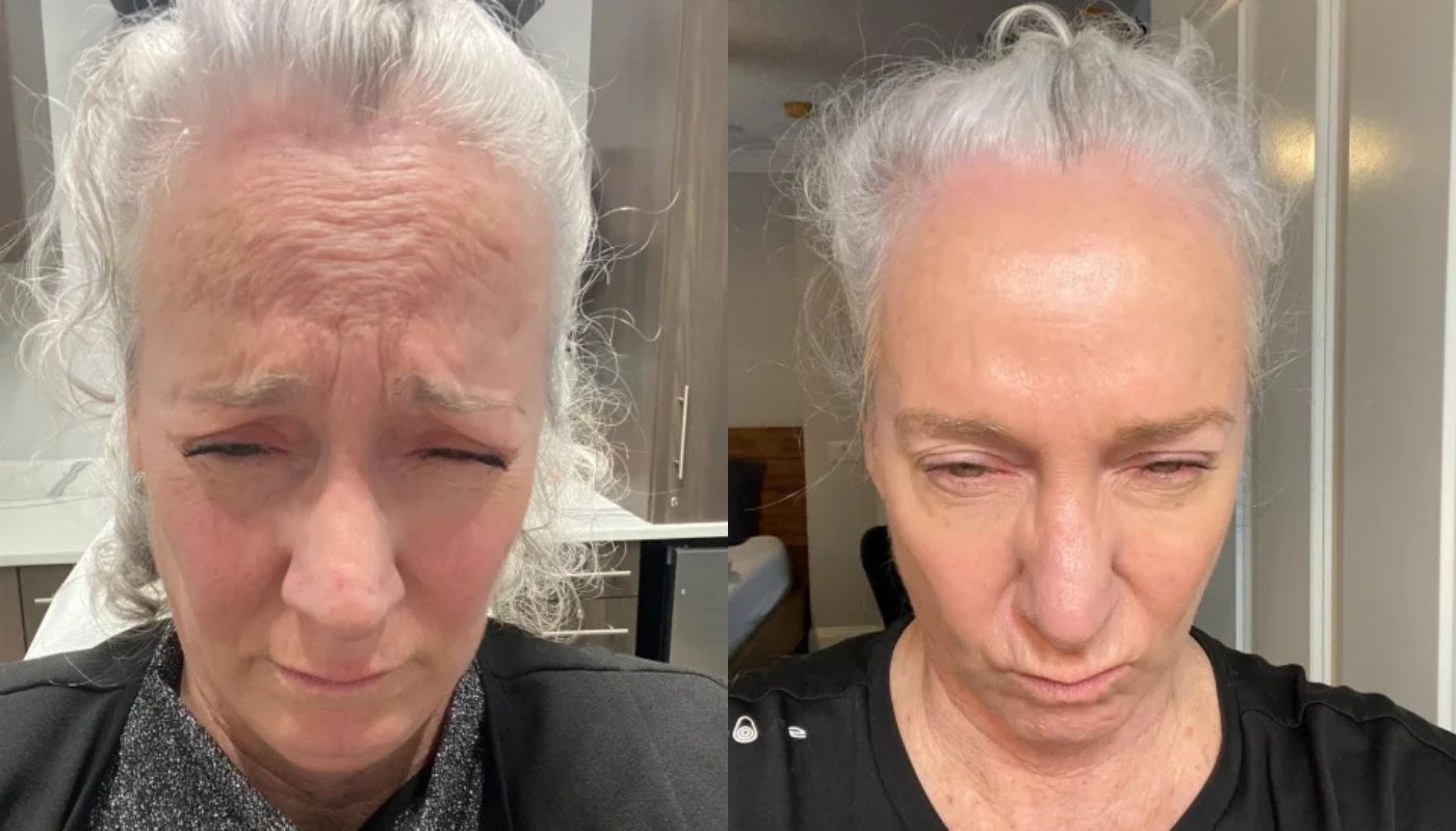 Daxxify before and after