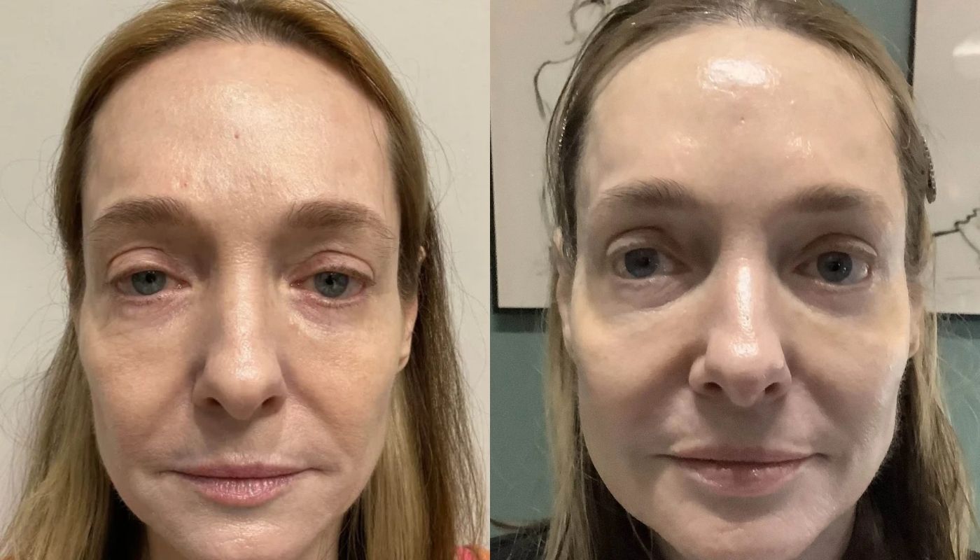 Daxxify before and after