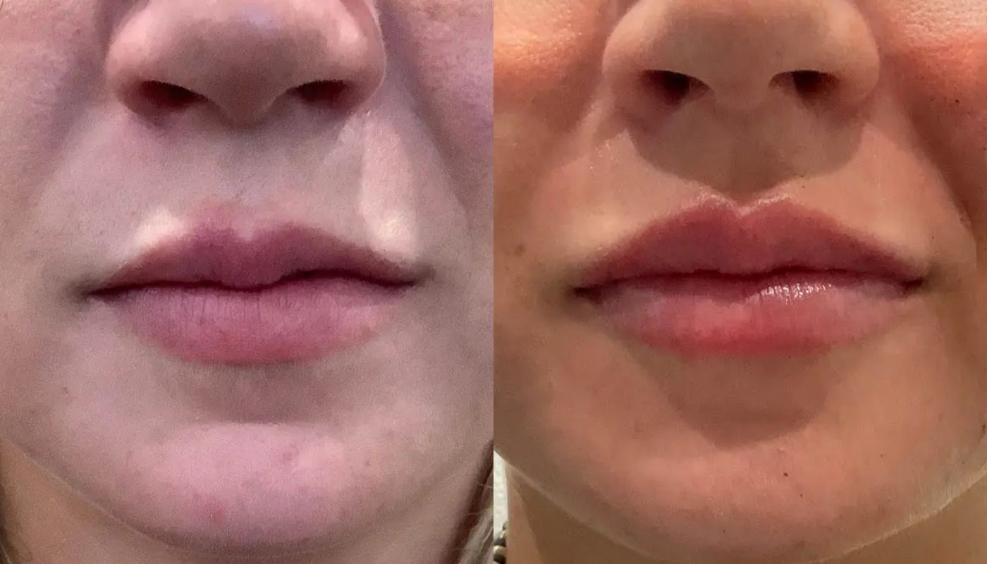 Dermal Fillers before and after