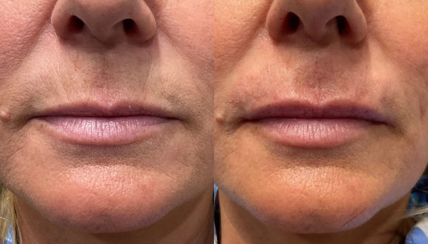 Dermal Fillers before and after