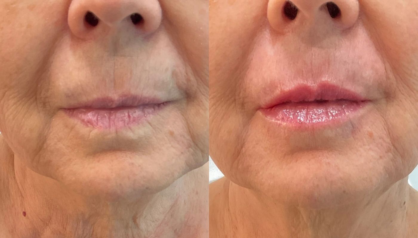 Dermal Fillers before and after