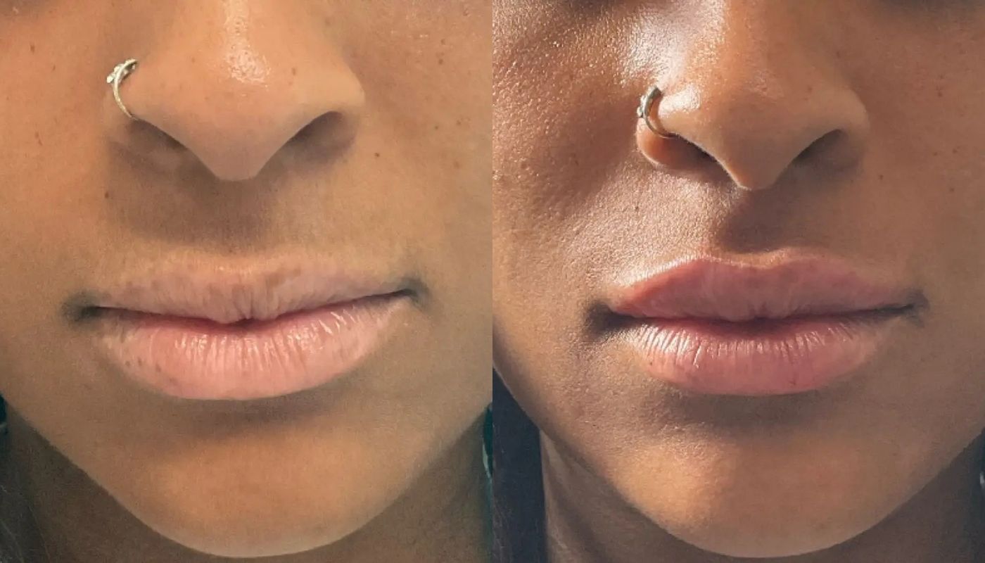 Dermal Fillers before and after