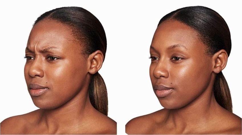 Dysport effect on frown lines