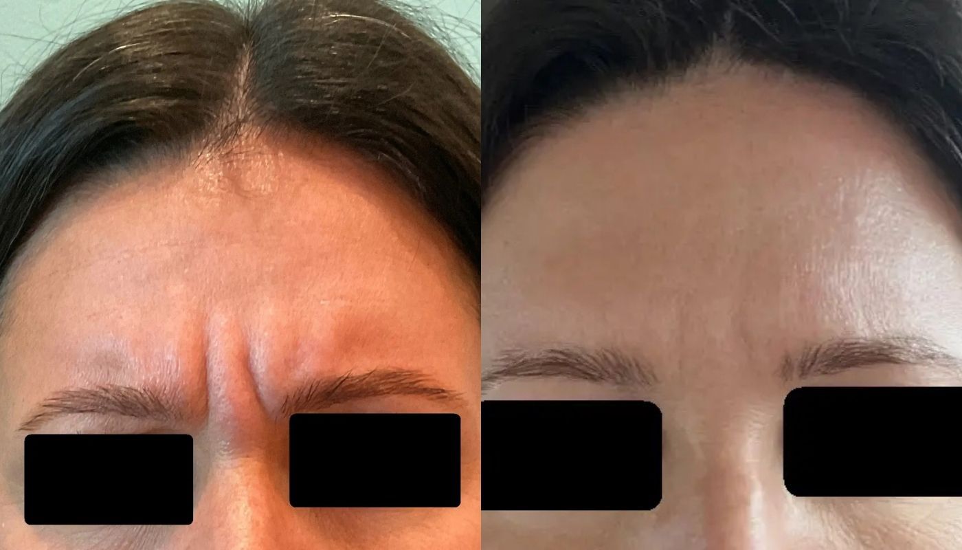 Dysport before and after