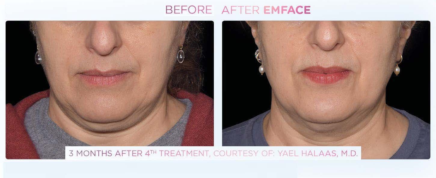 Emface - Before and After