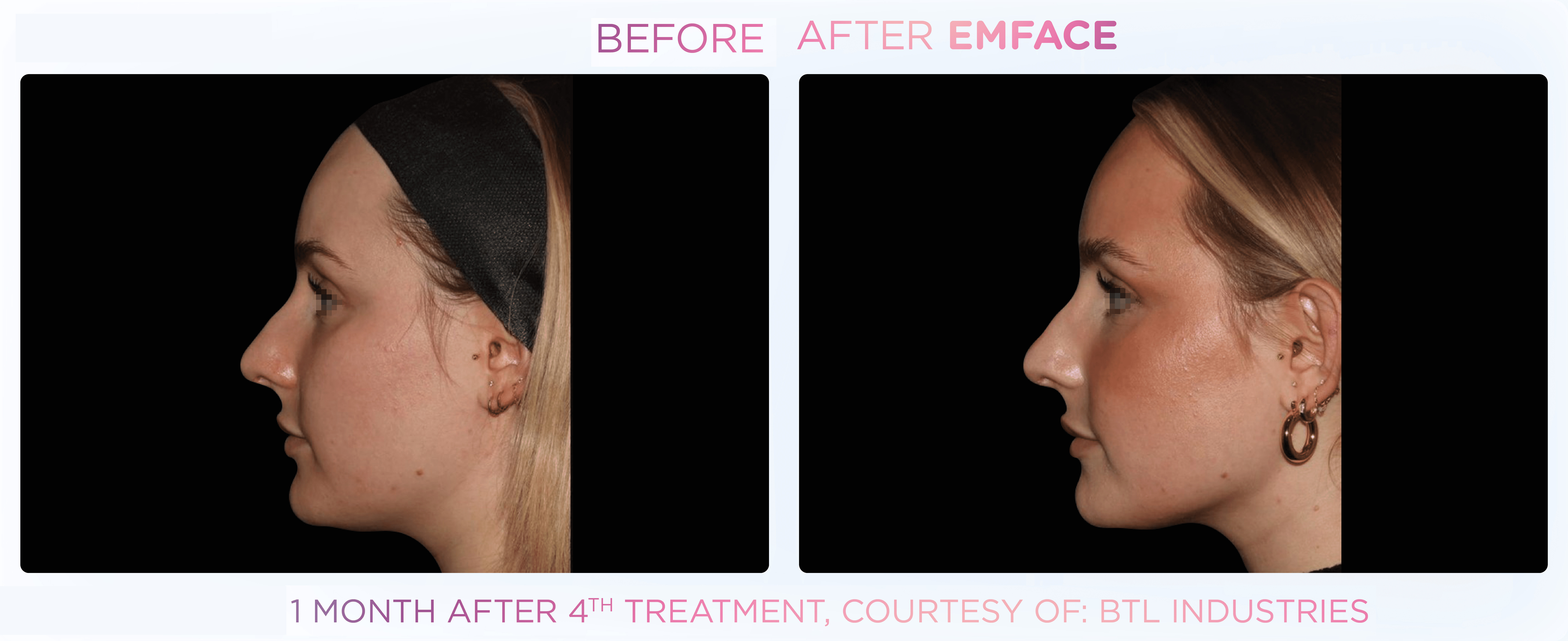 Emface effect on cheeks