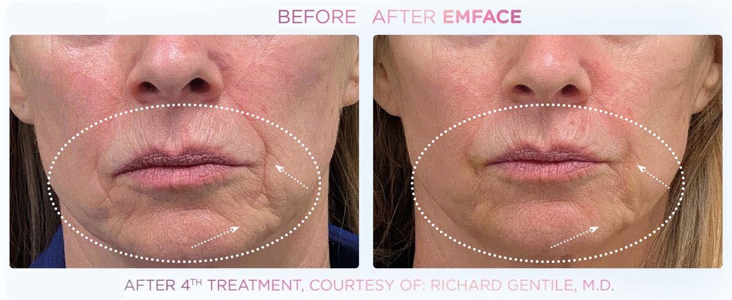 Emface effect on the mouth