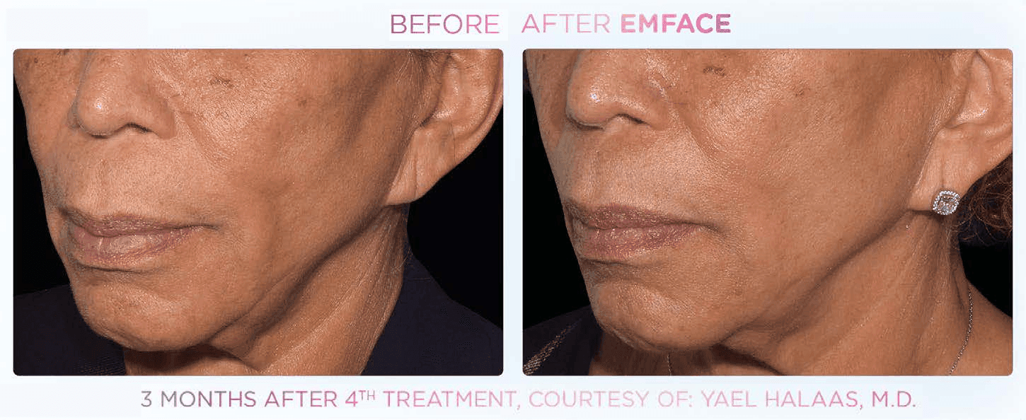 Emface - Before and After