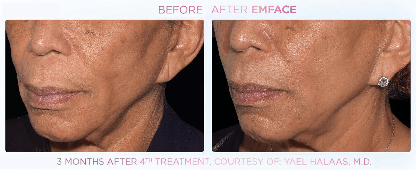 Emface effect on the cheeks