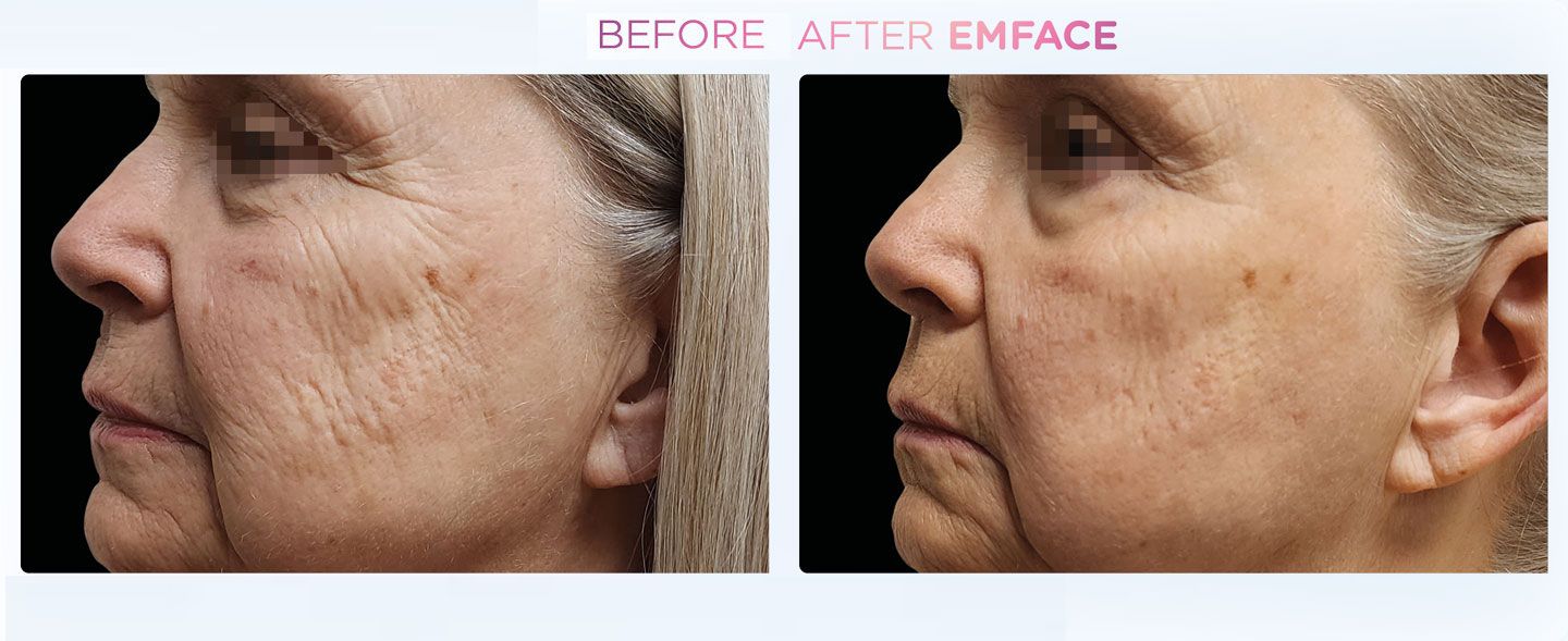 Emface - Before and After