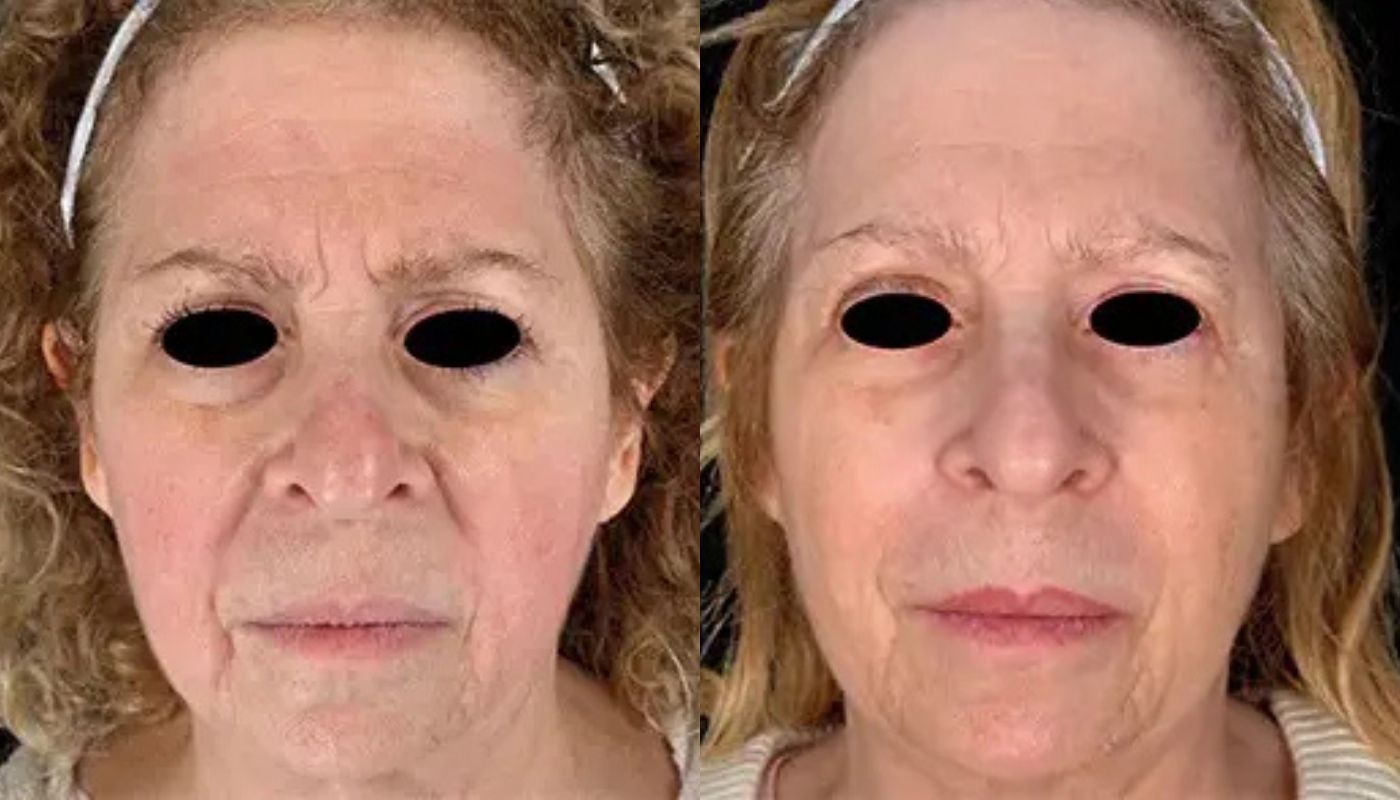 Emface before and after
