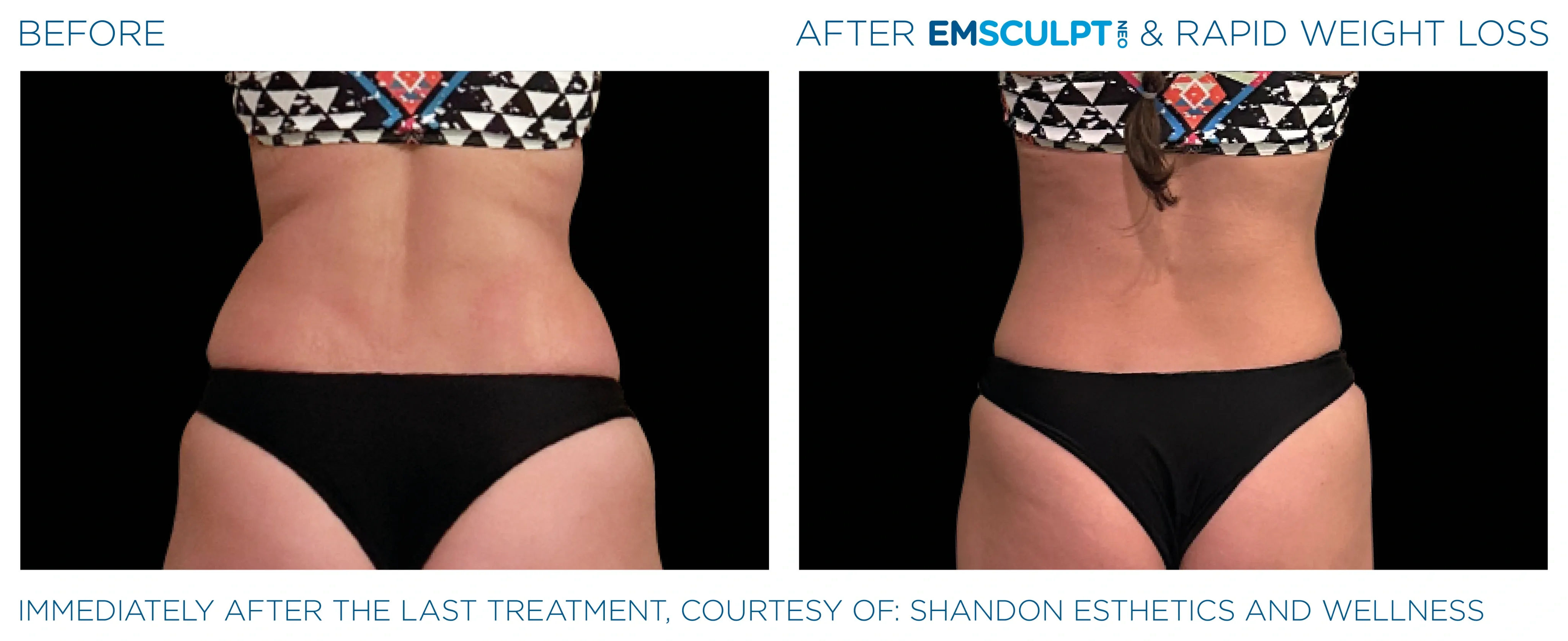 Emsculpt Neo before and after