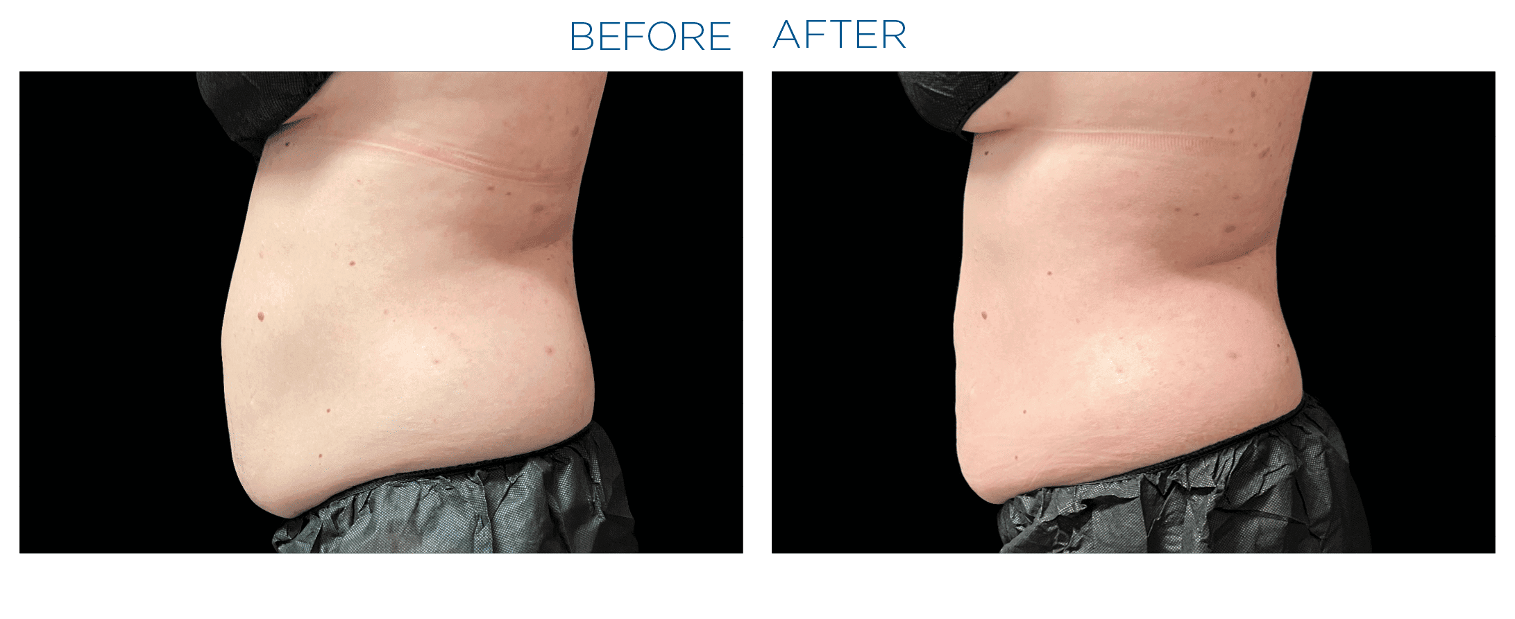 Emsculpt Neo - Before and After