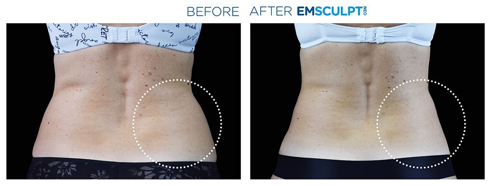 Emsculpt Neo - Before and After