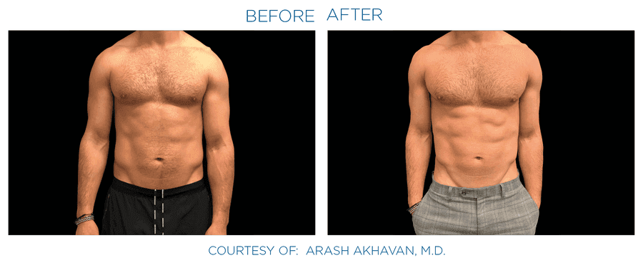 Emsculpt Neo effect on abdomen