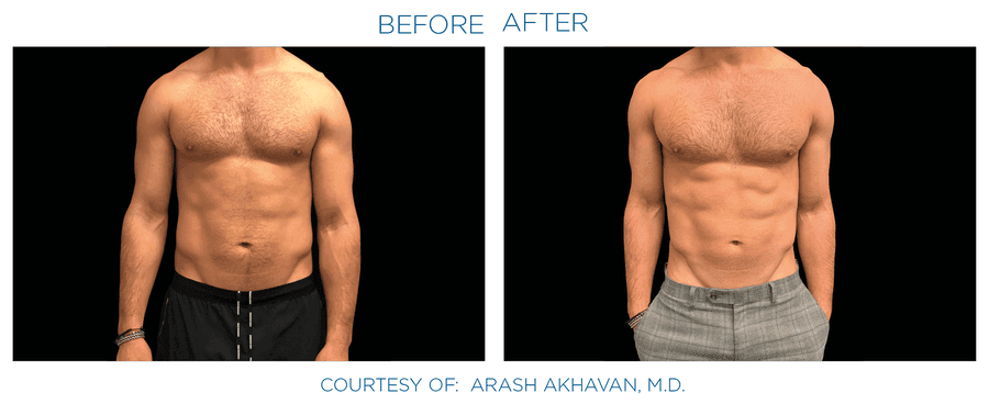 Emsculpt Neo effect on abdomen