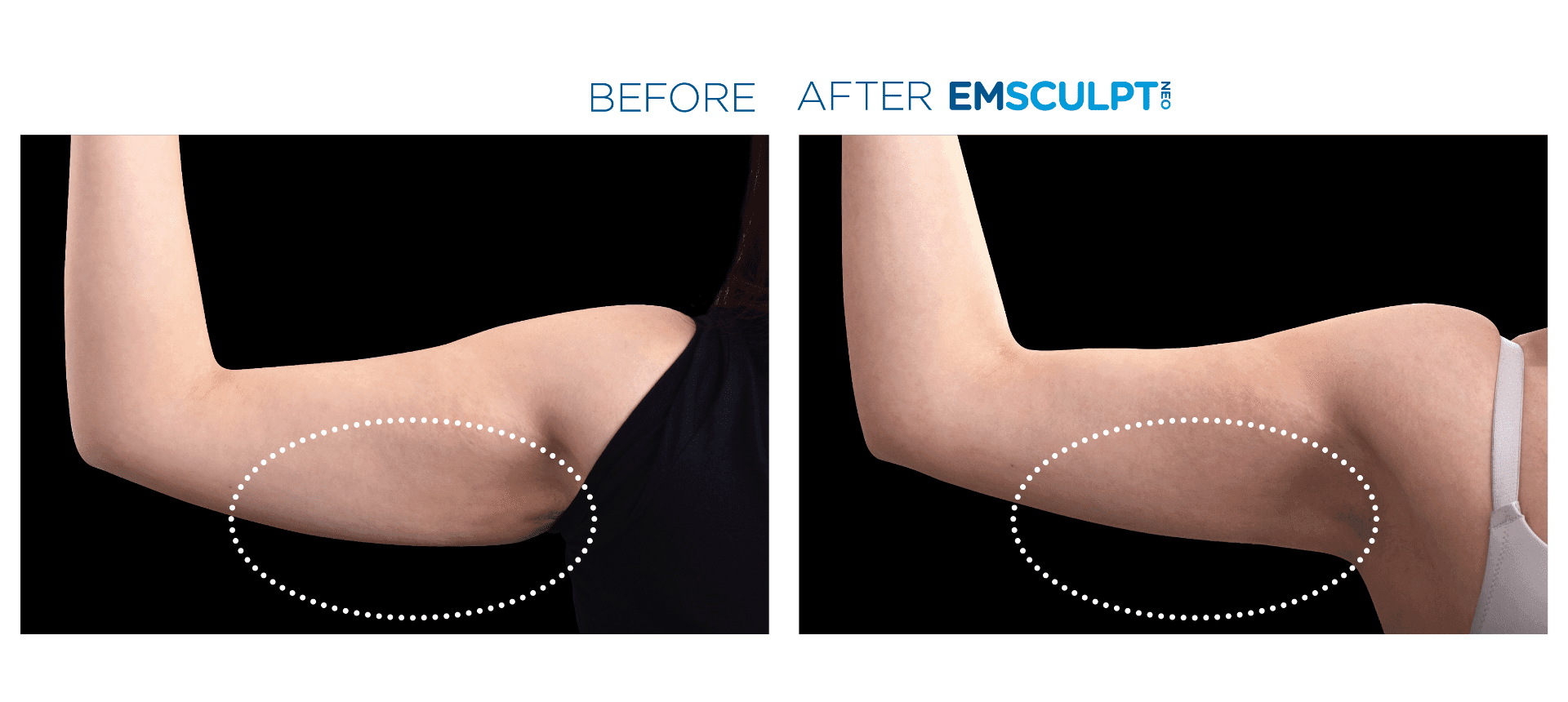 Emsculpt Neo - Before and After