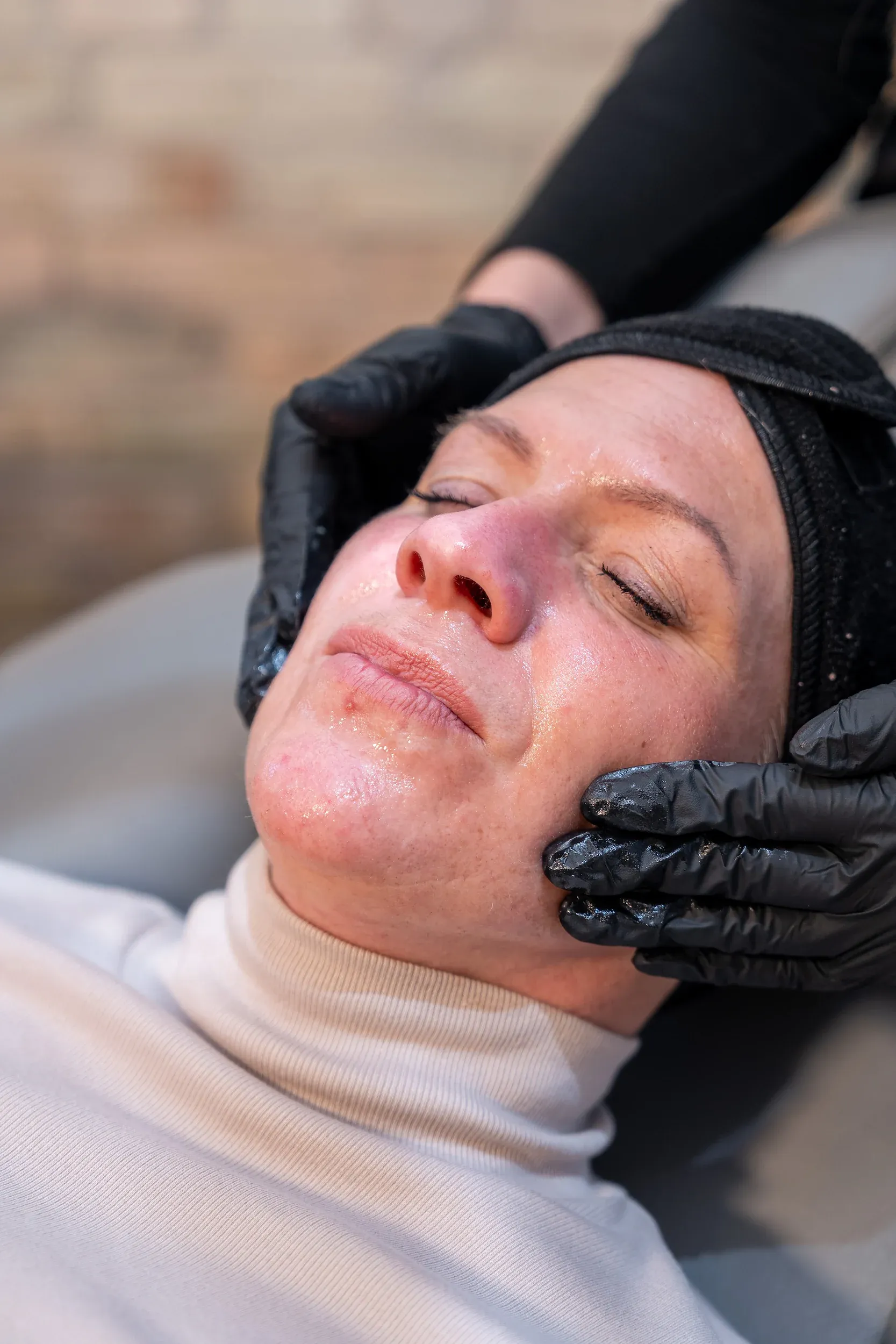 Before and after Helix CO2 laser results showing skin rejuvenation at Eternal Wellness Traverse City