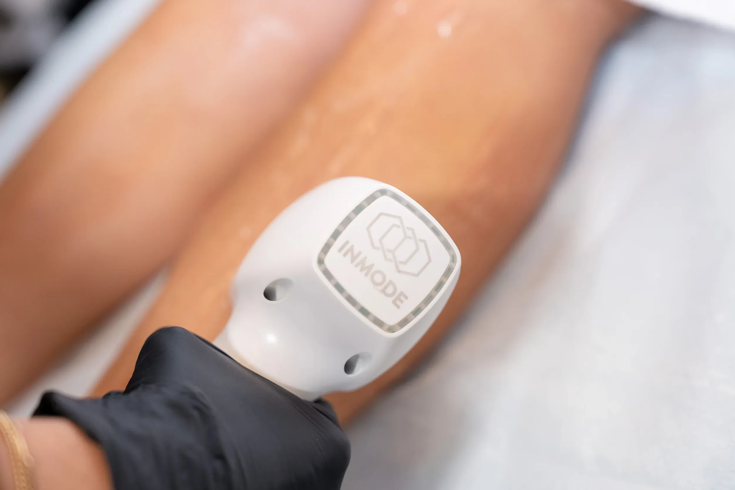 Before and after DiolazeXL laser hair removal results showing smooth skin at Eternal Wellness Traverse City