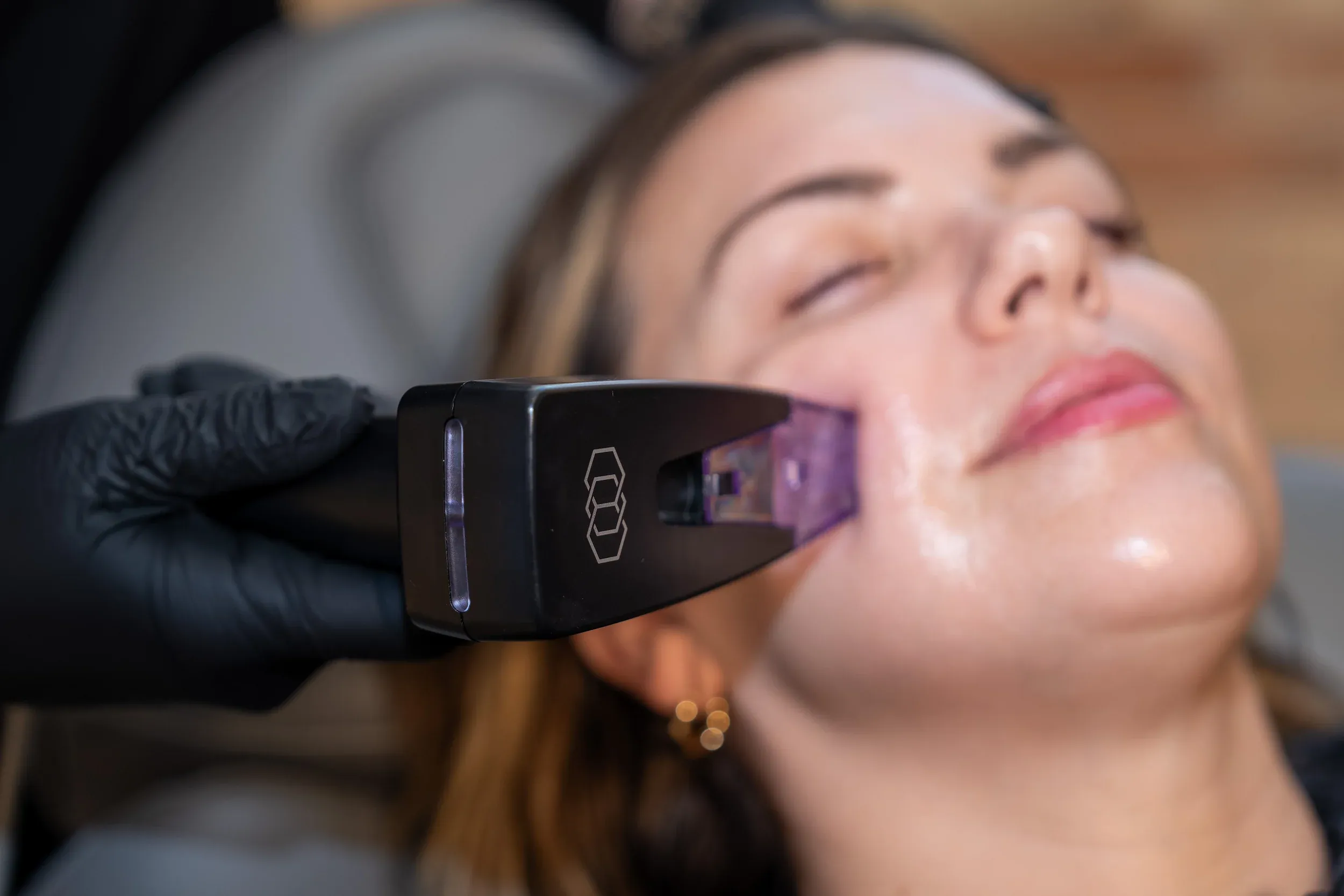 Morpheus8 RF Microneedling