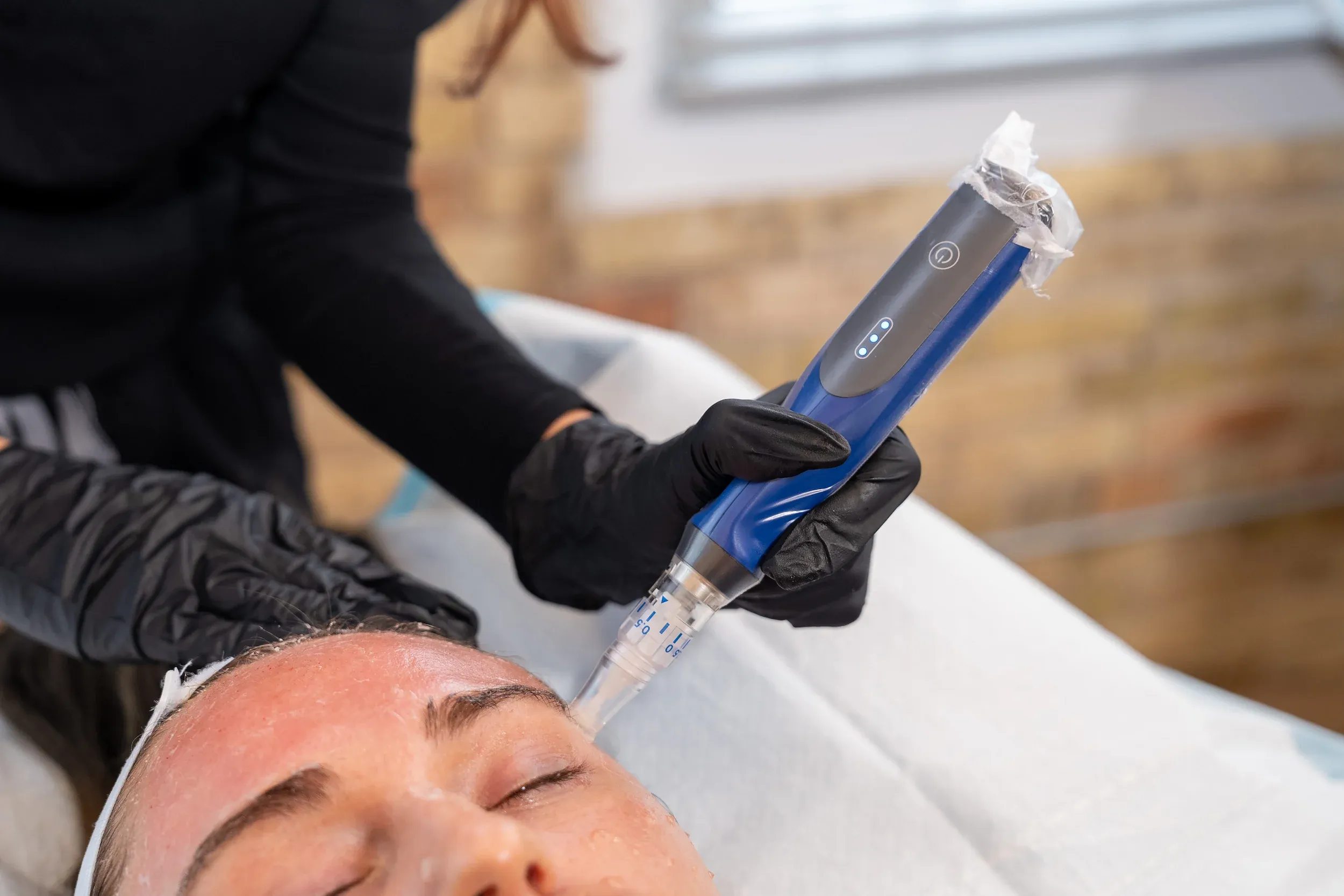 SkinPen microneedling treatment at Eternal Wellness Medical Spa in Traverse City MI