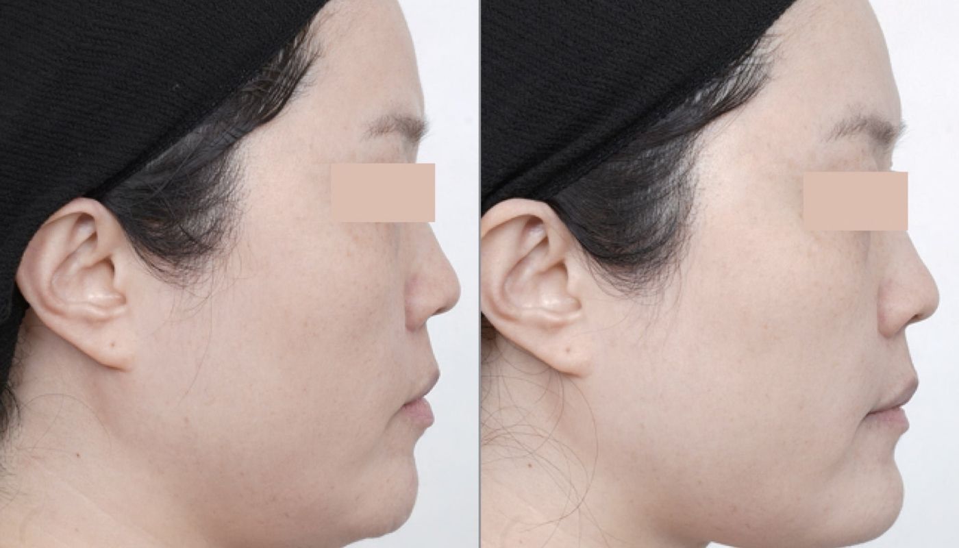 Everesse before and after
