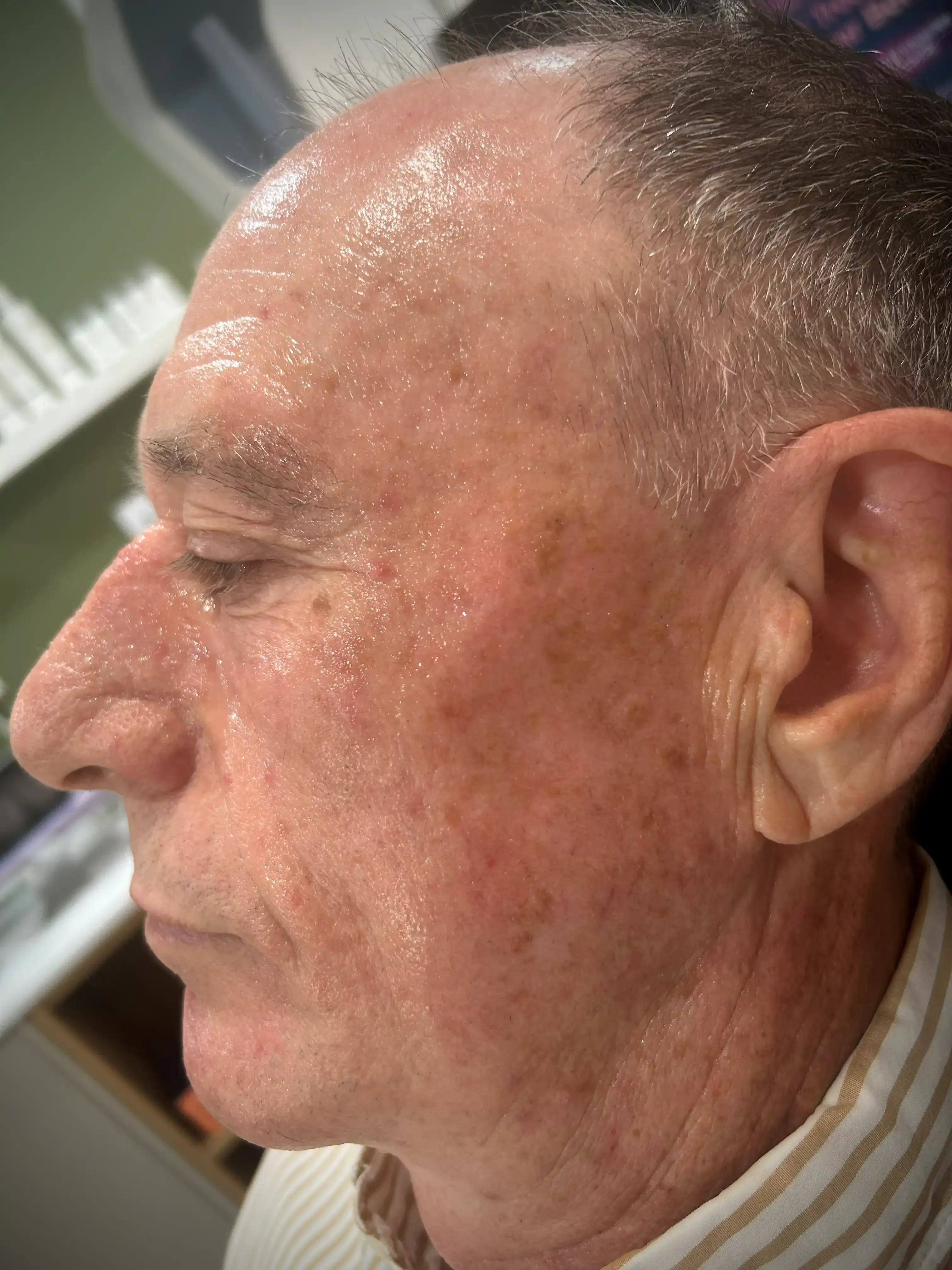 Close-up of uneven skin tone and sun damage addressed by Exion Clear RF