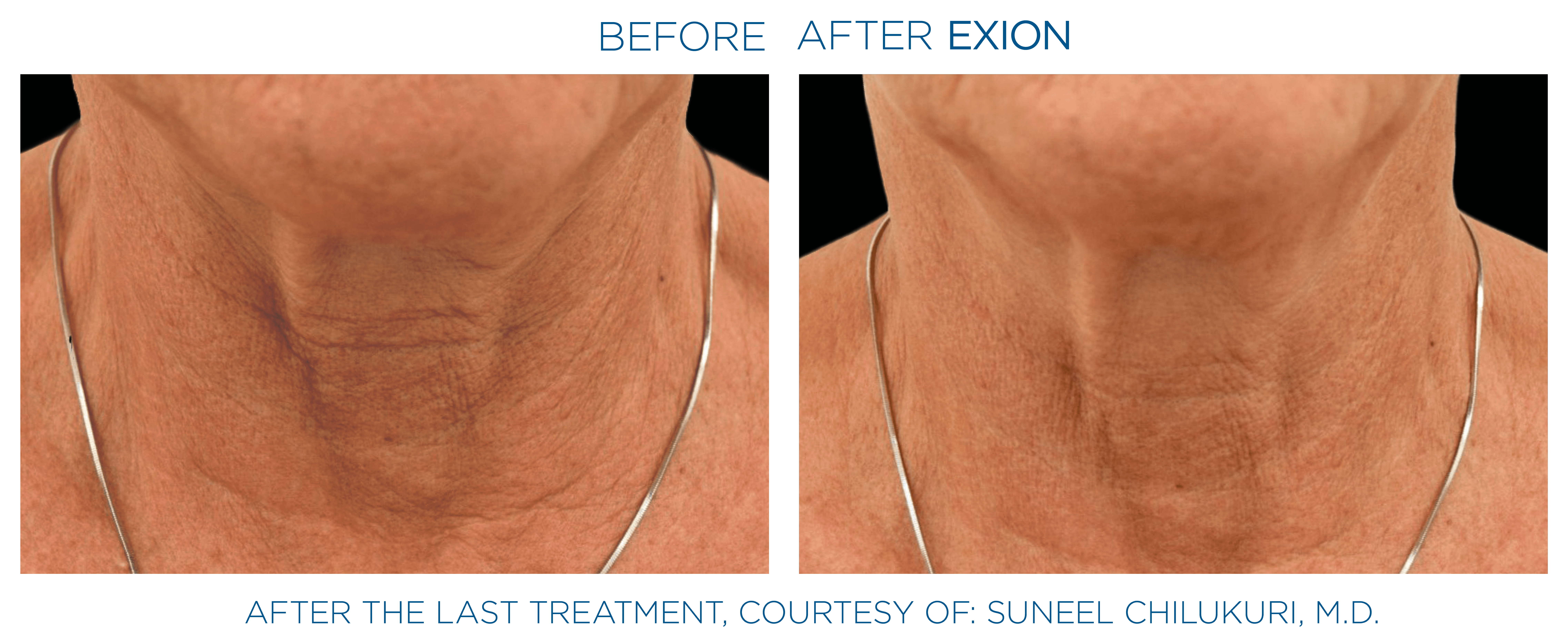 Exion effect on the neck area