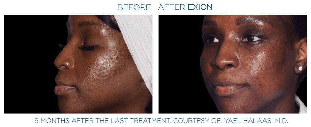 Exion effect on the face