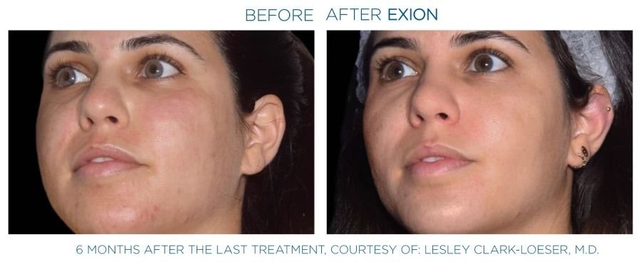Exion effect on the face